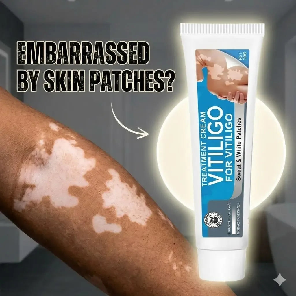 Vitiligo Cream, Natural Effective Vitiligo Treatment for Reduce White Spots and Improve Skin Pigmentation