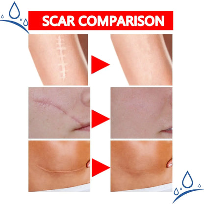 Professional and powerful scar removal gel - suitable for scar removal treatment of post-operative scars, caesarean section scars, keloids, burns, acne, etc.-A
